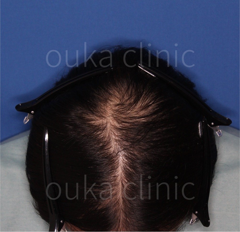 頭頂　生え際　分け目の治療前の画像