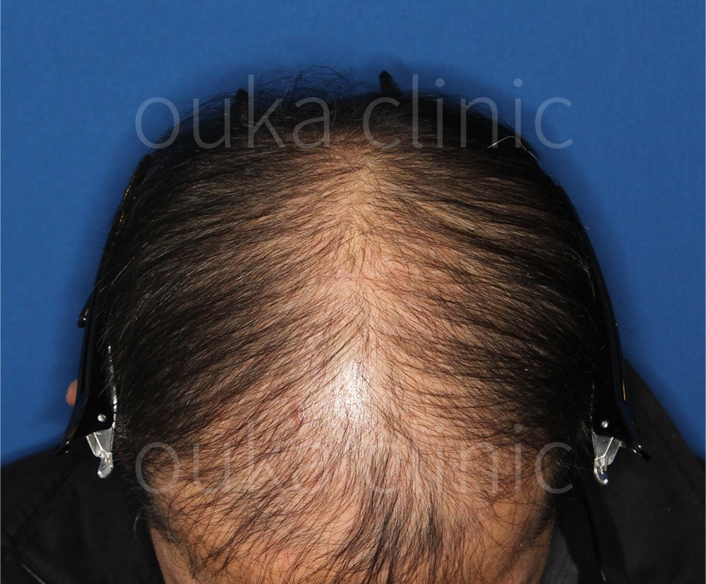 生え際　頭頂の治療前の画像