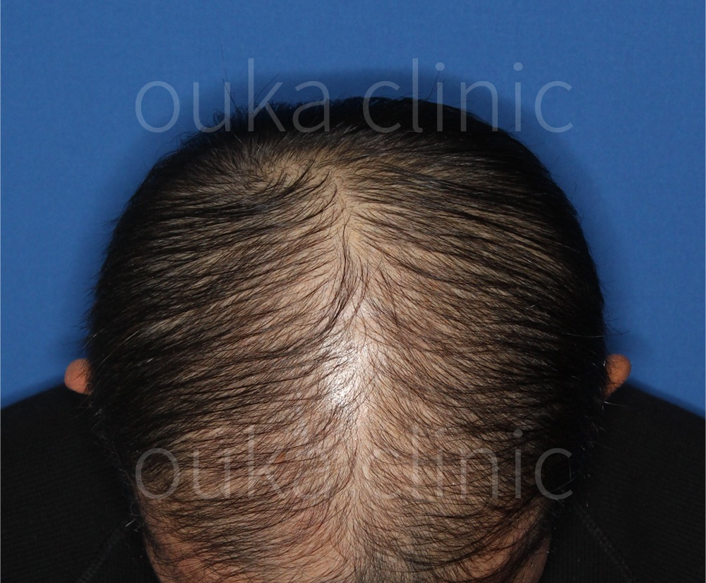 生え際　頭頂の治療後の画像