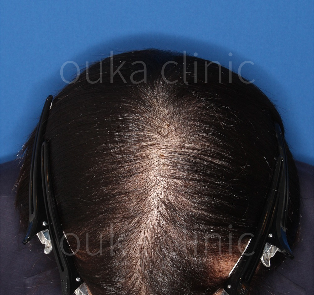 頭頂　生え際　分け目の治療前の画像