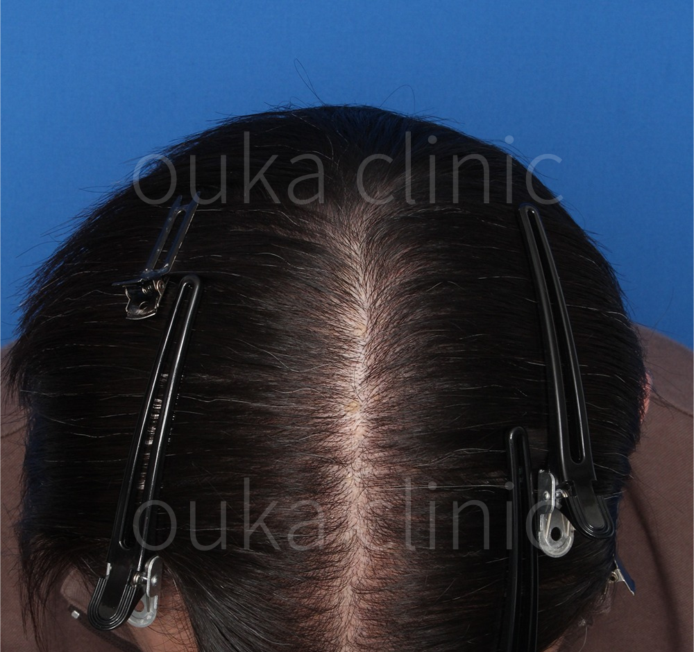 頭頂　生え際　分け目の治療後の画像