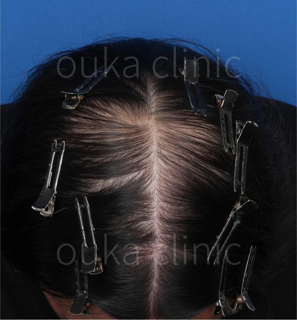 頭頂の治療後の画像