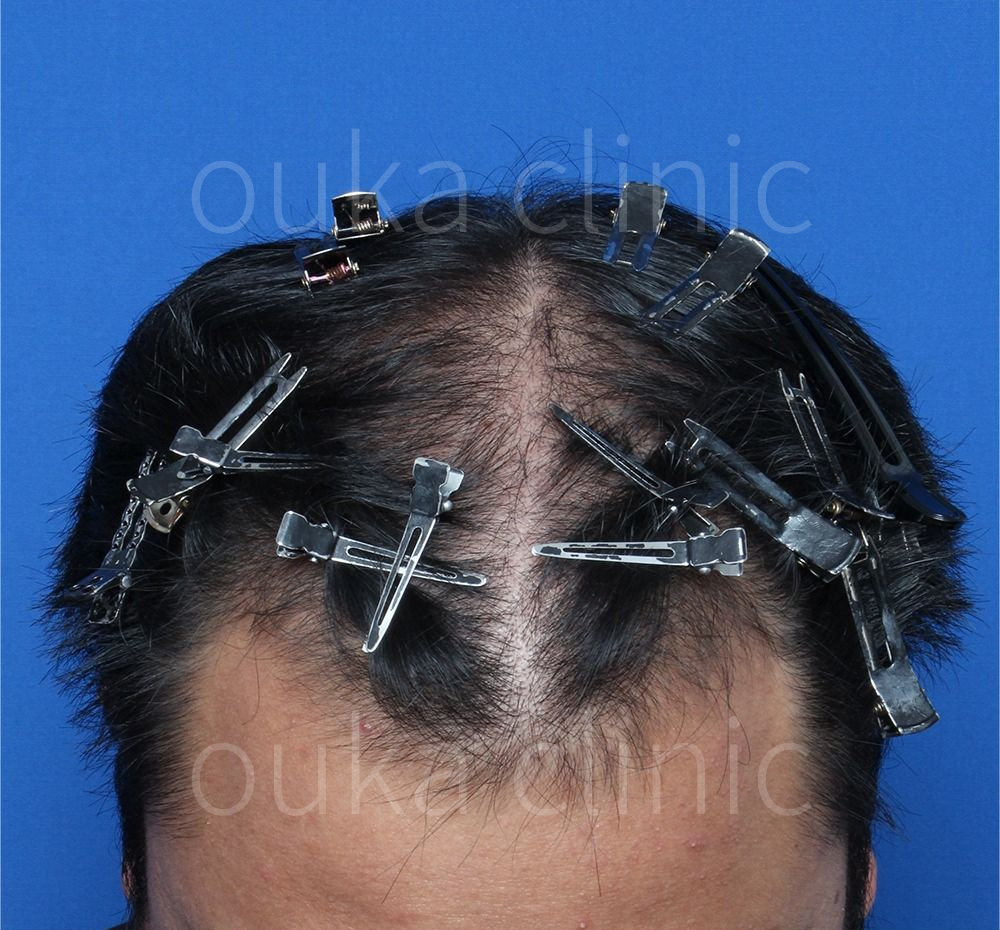 はえ際　頭頂の治療前の画像