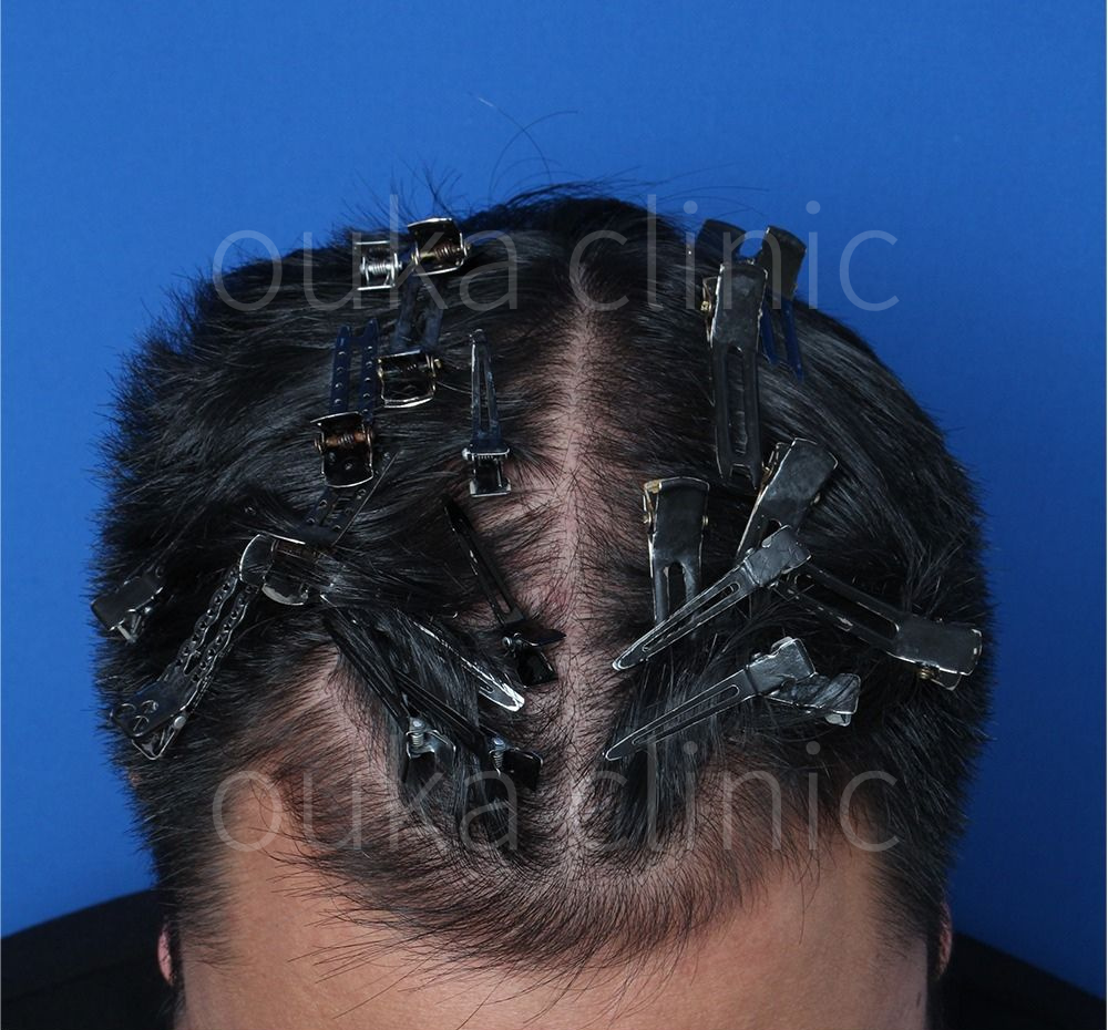 はえ際　頭頂の治療後の画像