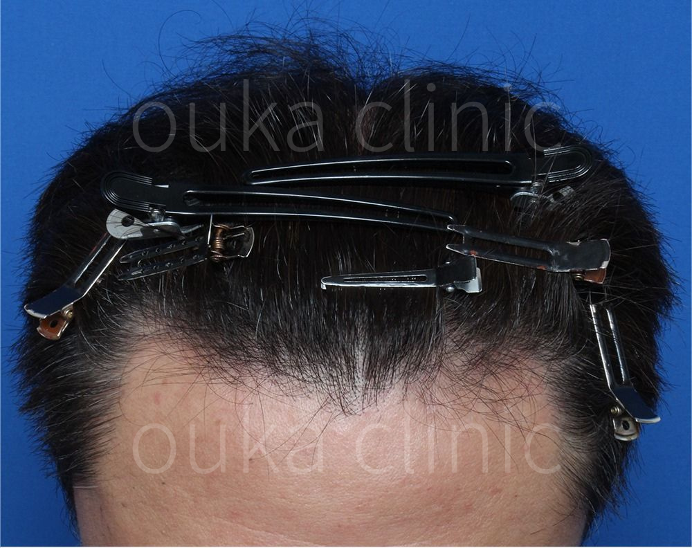 頭頂　生え際の治療後の画像