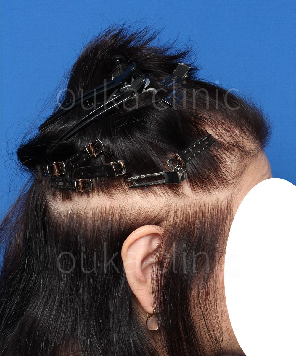 生え際、頭頂、分け目の治療前の画像