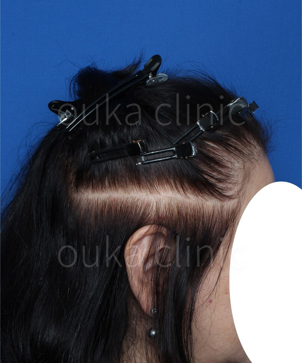 生え際、頭頂、分け目の治療後の画像