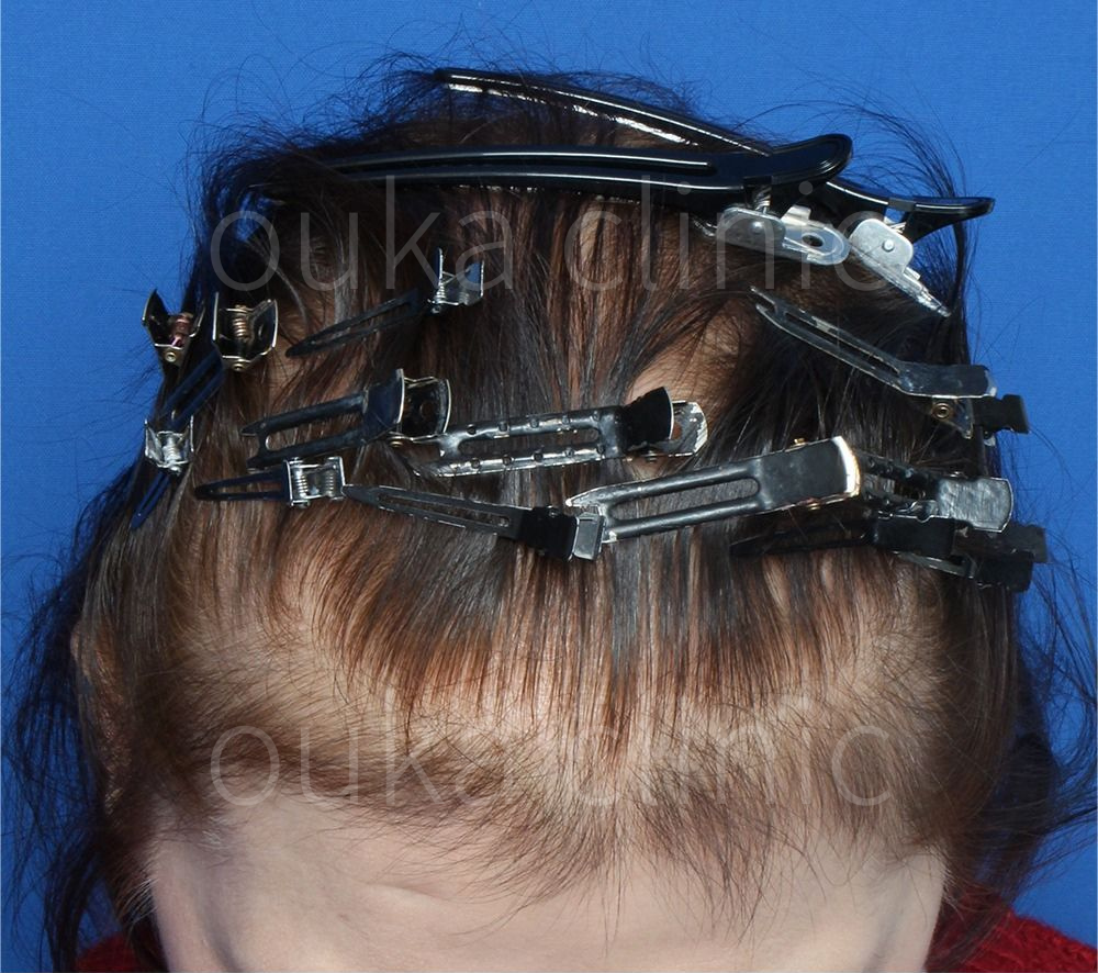 全体の治療後の画像