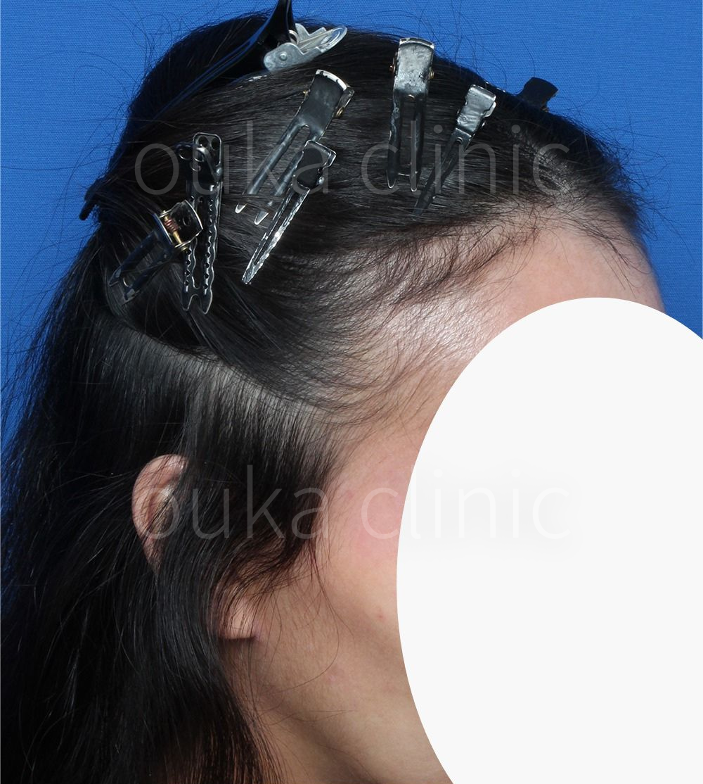 生え際、分け目の治療後の画像