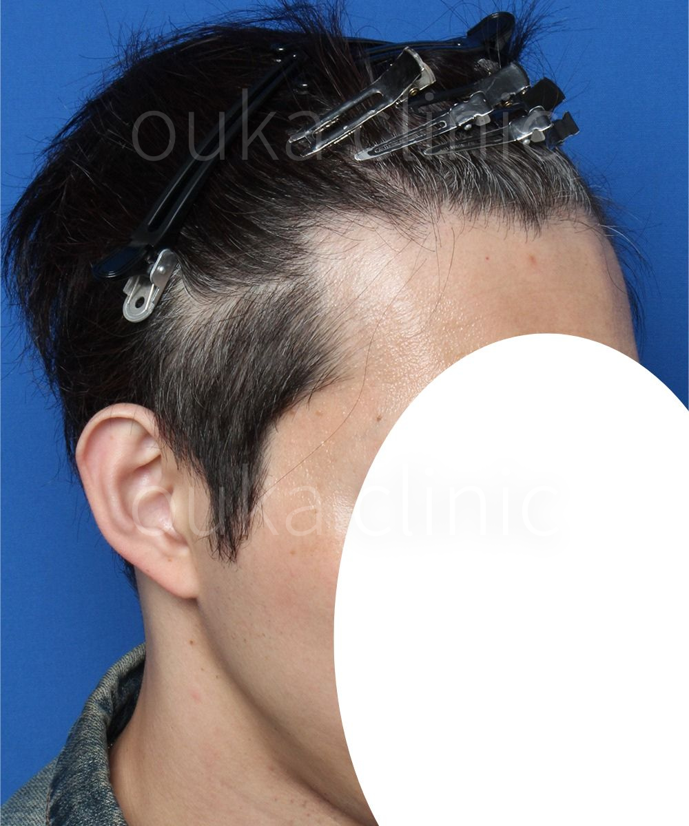 M字　頭頂の治療前の画像