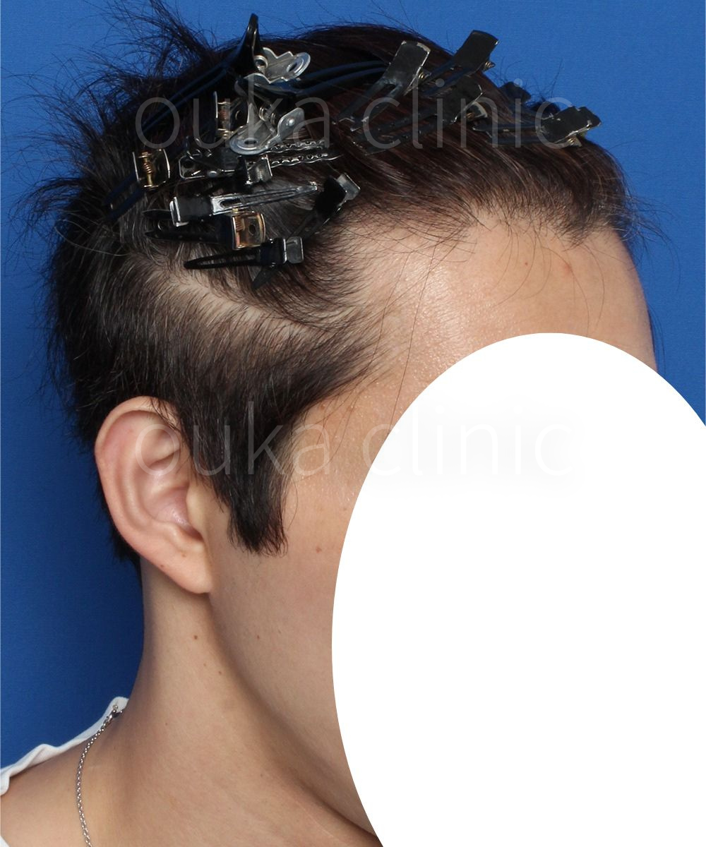 M字　頭頂の治療後の画像