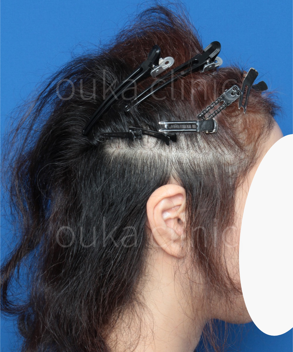 生え際の治療前の画像