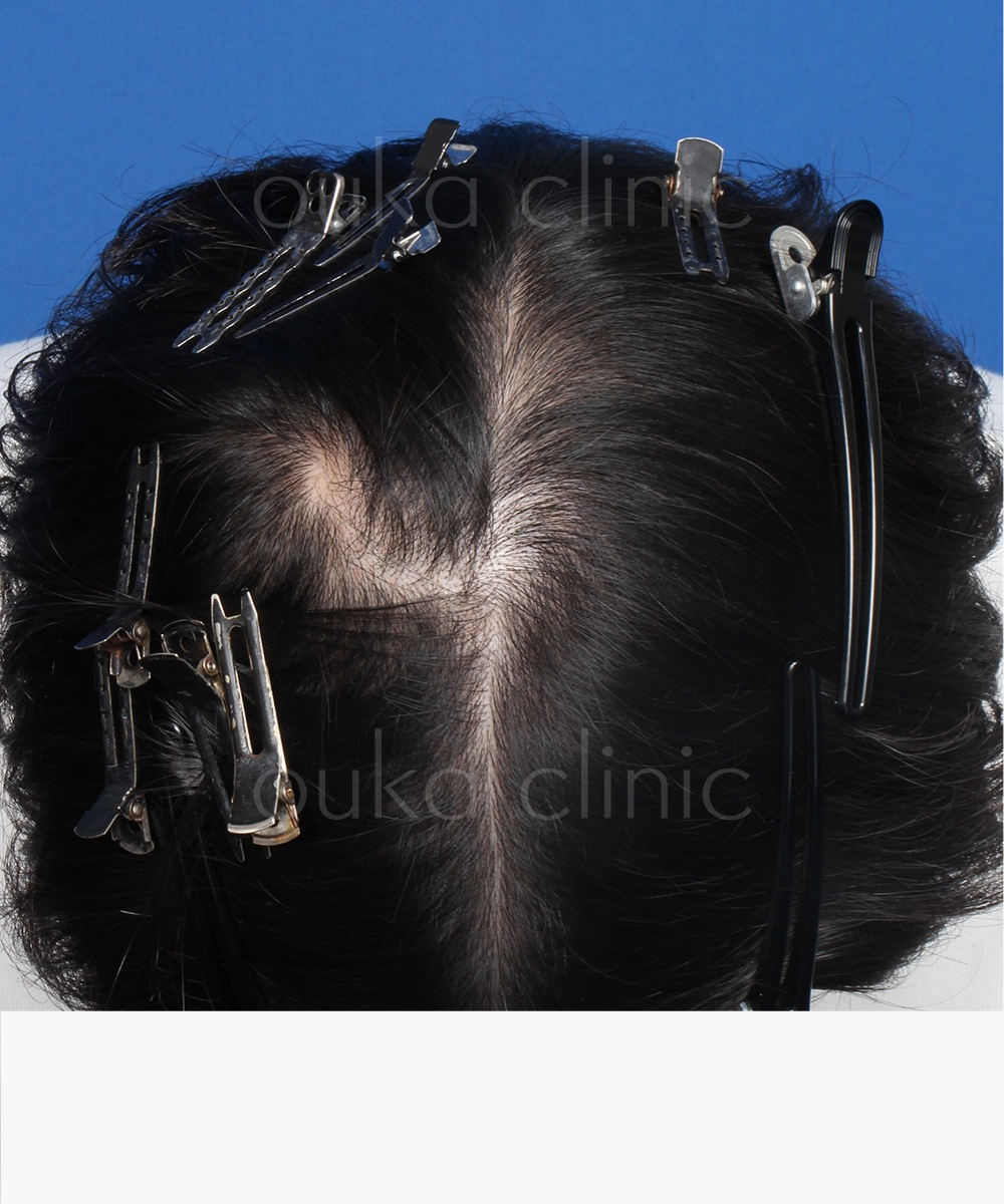 頭頂の治療前の画像